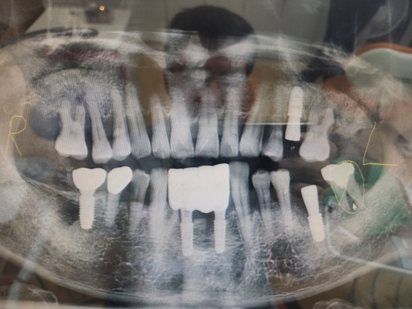임플란트 시술 후 파노라마 X-ray 사진